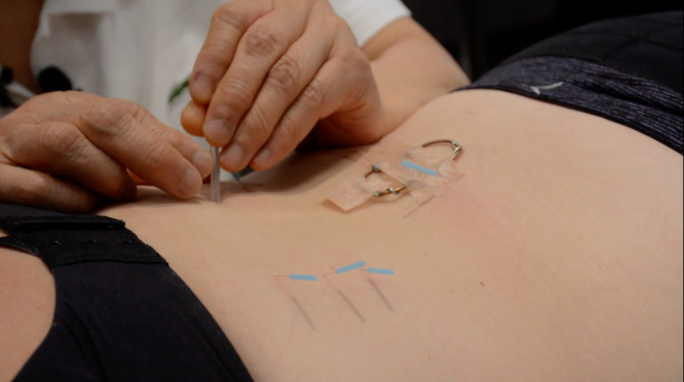 Acupuncture Dry Needling at AcuMed